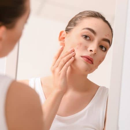 what is causing your acne and pimples