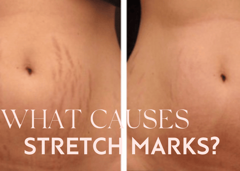 itchy stretch marks on stomach