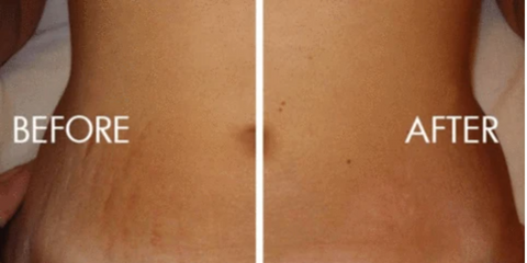 stretch mark before and after picture