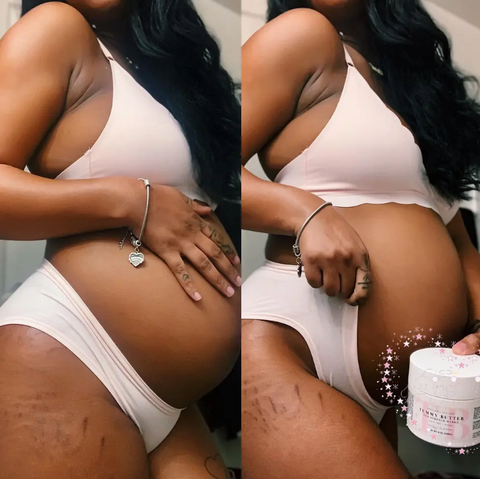 ic:stretch marks on things during pregnancy