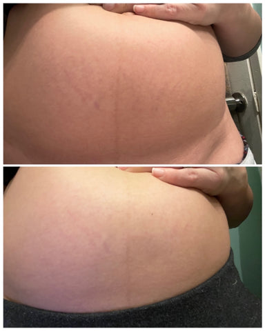 ic:before and after using tummy butter stretch mark treatment