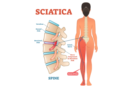 what is sciatica