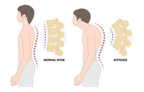 humchback posture