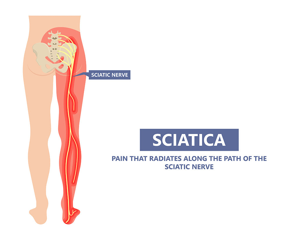 sciatica nerve pain located