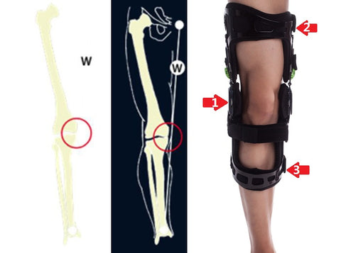 Valgus off-loading brace for Right Leg