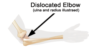 Dislocated elbow