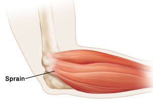Elbow sprain