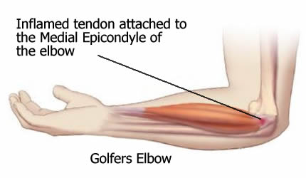 Golfers elbow