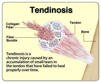 Tendinosis