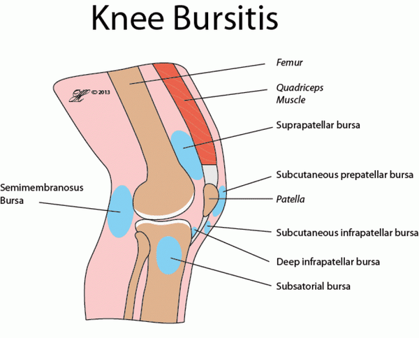 knee-bursitis