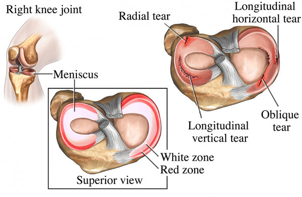 meniscus-tear