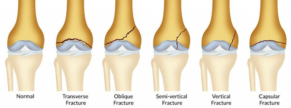 knee-fractures