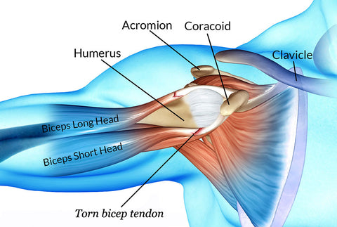 Torn bicep tendon