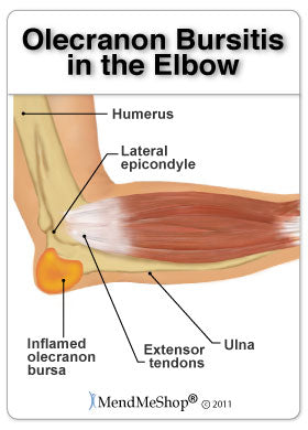 olecranon-bursitis-in-the-elbow