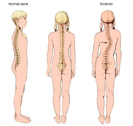 tlso brace for scoliosis