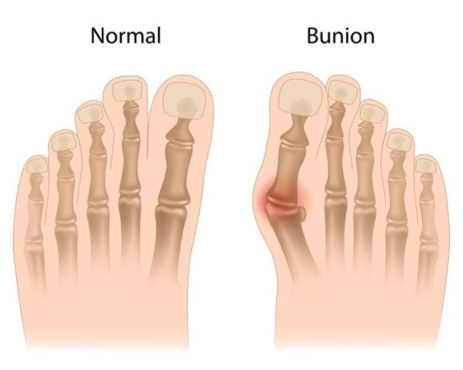 Relieves pain caused by bunions, Hallux Valgus and crooked toes Protects bunions and crooked toes from friction, pressure and irritation Separates and realigns big toe