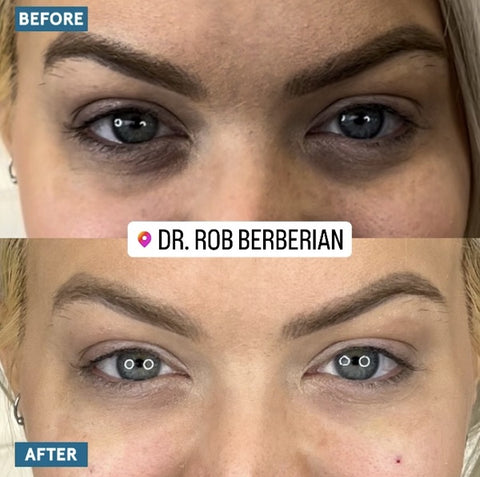 Celebrity Under Eye Treatment Dr. Rob Berberian Newport Beach