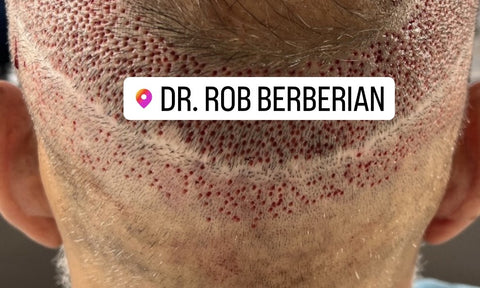 Dr. Rob Berberian - FUT scar - Botched Hair Transplant - FUE Hair Transplant - Los Angeles & Newport Beach