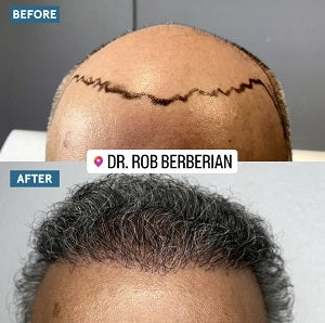 Dr. Rob Berberian - Hair Cloning- FUE Hair Transplant - Los Angeles & Orange County