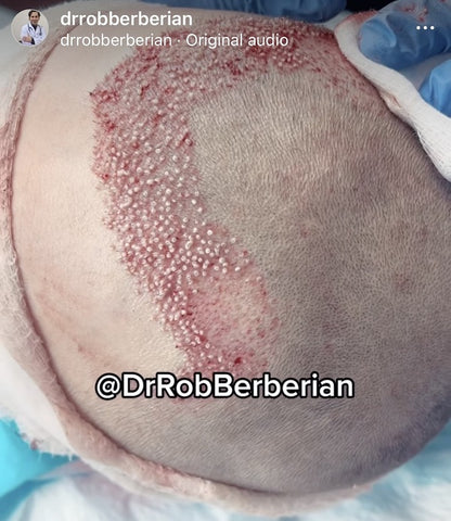 Dr. Rob Berberian FUE Hair Transplant Los Angeles Newport Beach