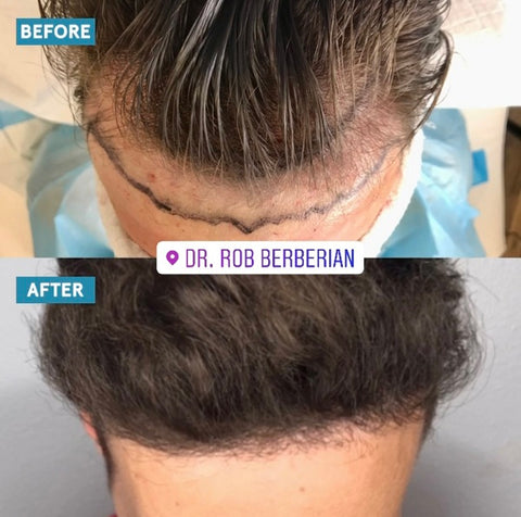 Dr. Rob Berberian - FUE Hair Transplant - Newport Beach & Los Angeles
