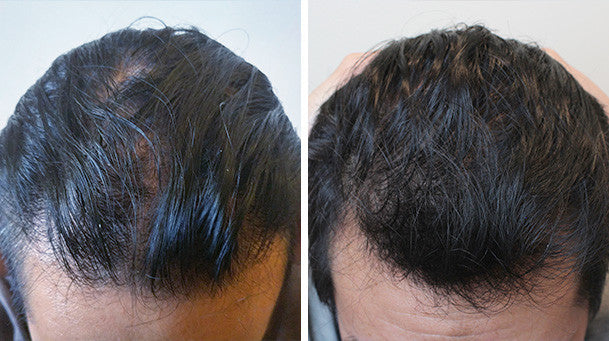 hair growth laser before irestore loss system grow regrowth results treatment restoration phil testimonial months helmet really