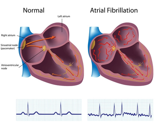 Chart depicting Atrial Fibrillation vs a normal heart beat