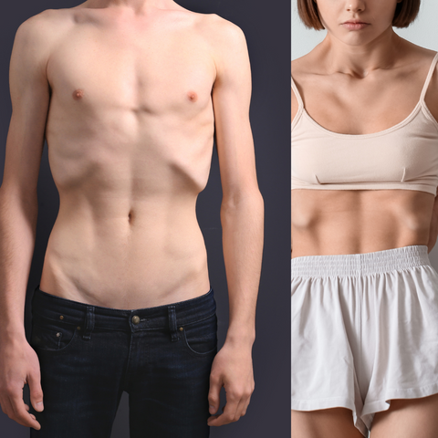 Thin Male and female suffering from Hyperthyroidism