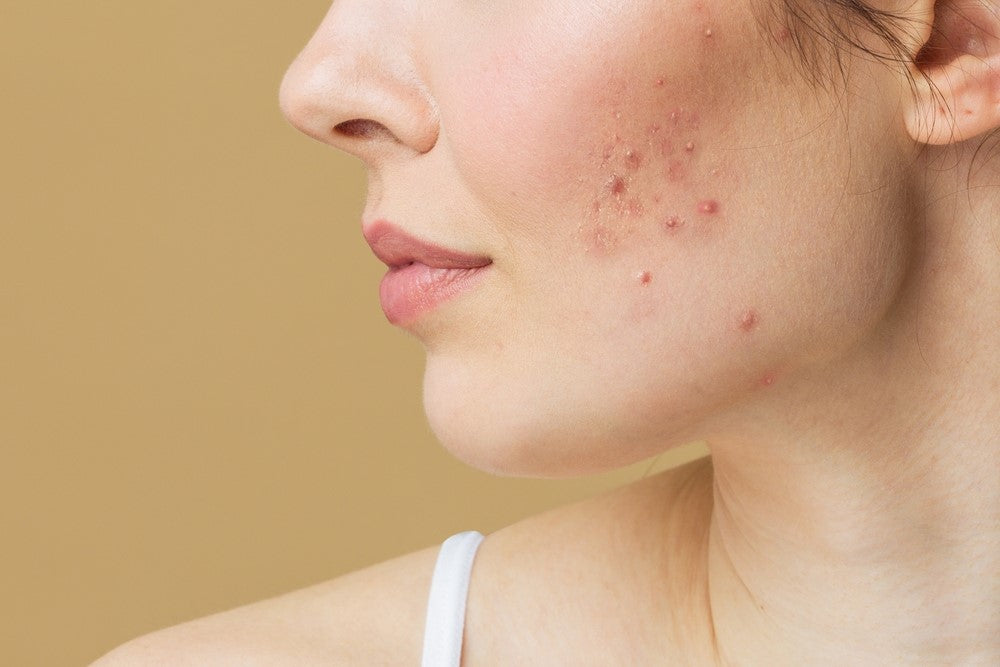 Acne Scars Treatment Laser in Houston