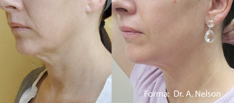 Forma skin tightening with Inmode technology
