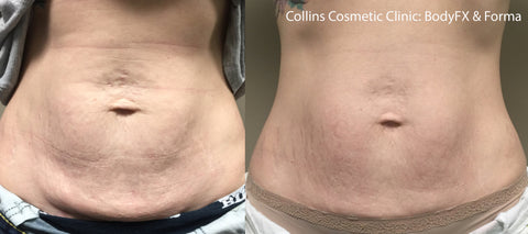 BodyFX skin tightening and body contouring tummy tuck