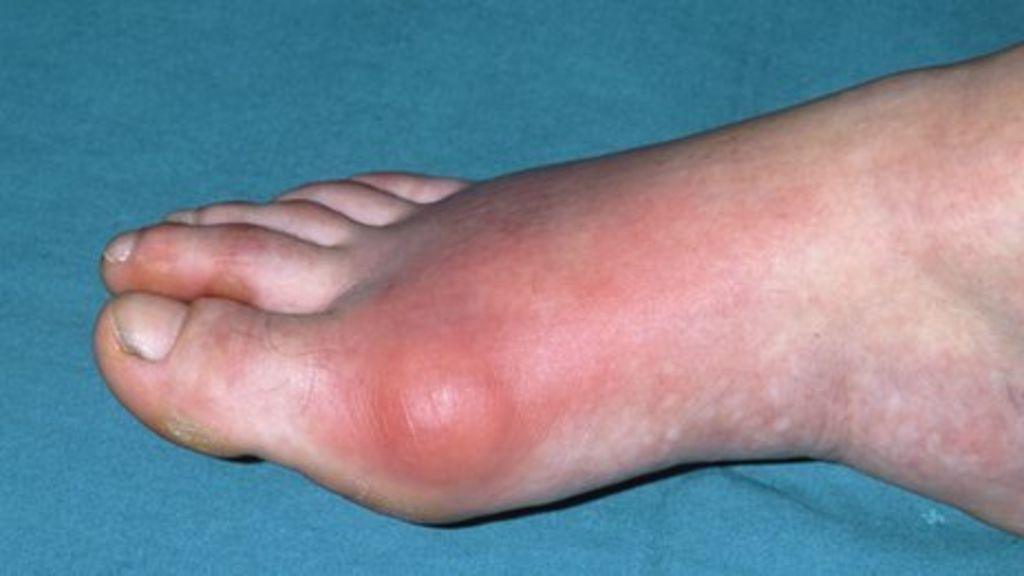 Got gout?  End it in 24 hours or less!