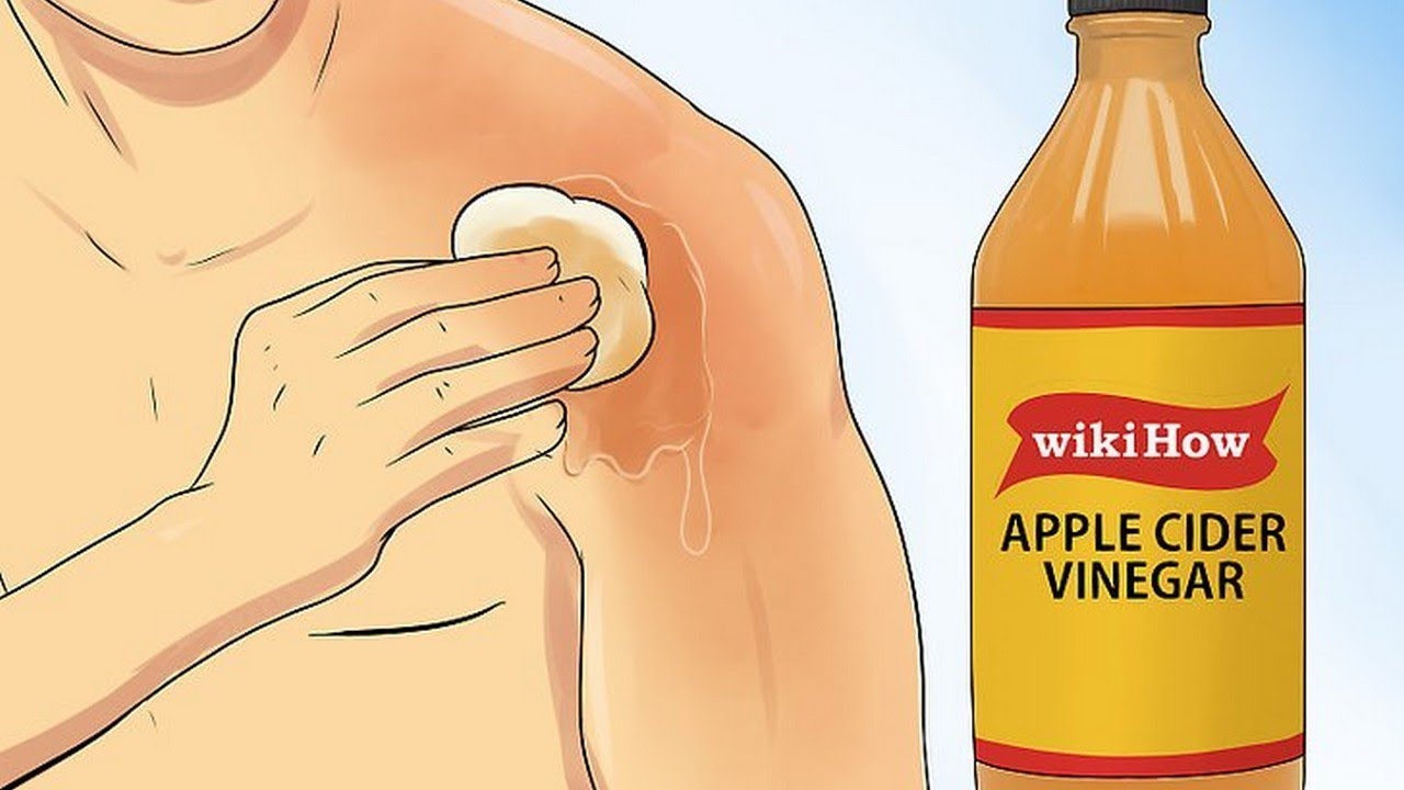 Apple cider vinegar for a sunburn! Takes away the Sting and leaves
