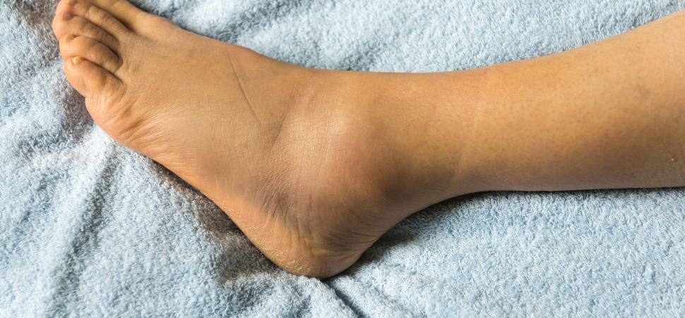 Sprained Ankle - Recovery Time - How Long & How to Aid Healing?