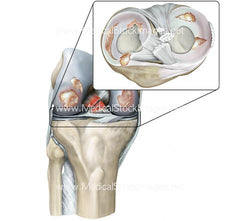 Knee joint Damage from Rheumatoid Arthritis 