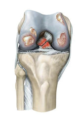 Rheumatoid Arthritis of the Knee Joint