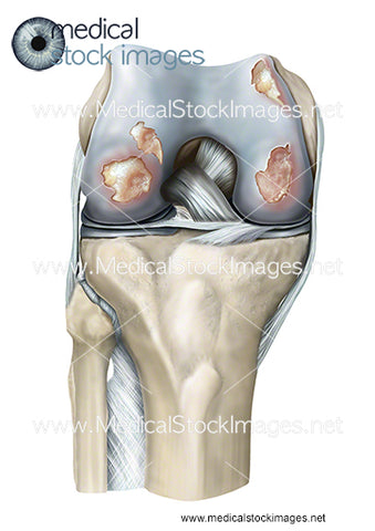 RA Images: Rheumatoid Arthritis Image of the Knee Joint
