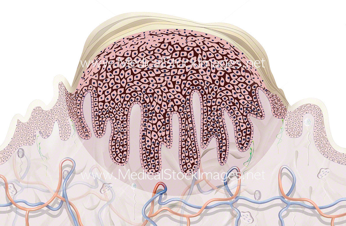 Anatomy of a Common Wart Illustration | Medical Stock ... diagram of hpv wart 