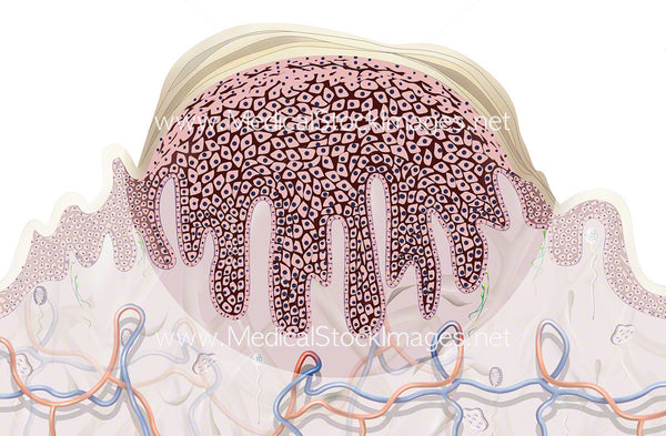 Anatomy of a Common Wart Illustration | Medical Stock – Medical Stock