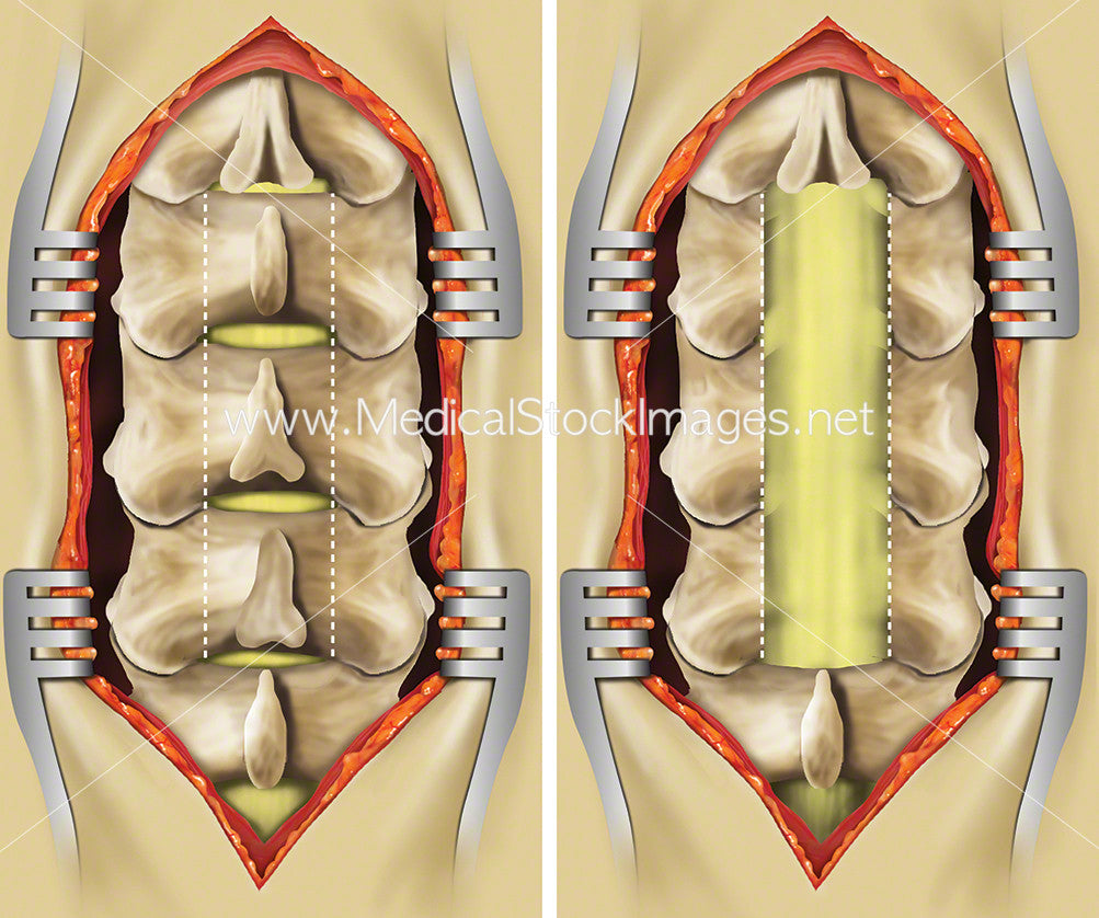 laminectomy