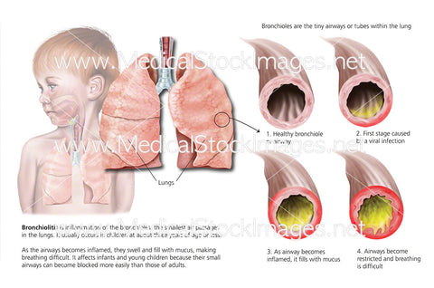 if the bronchioles are dilated the anatomic dead space and tidal volume will