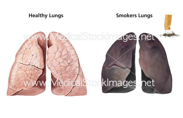 Healthy Lungs And Smoker S Lungs Medical Stock Images Company