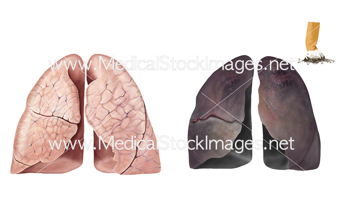 Healthy Lungs and Smoker’s Lungs – No Labels – Medical Stock Images Company