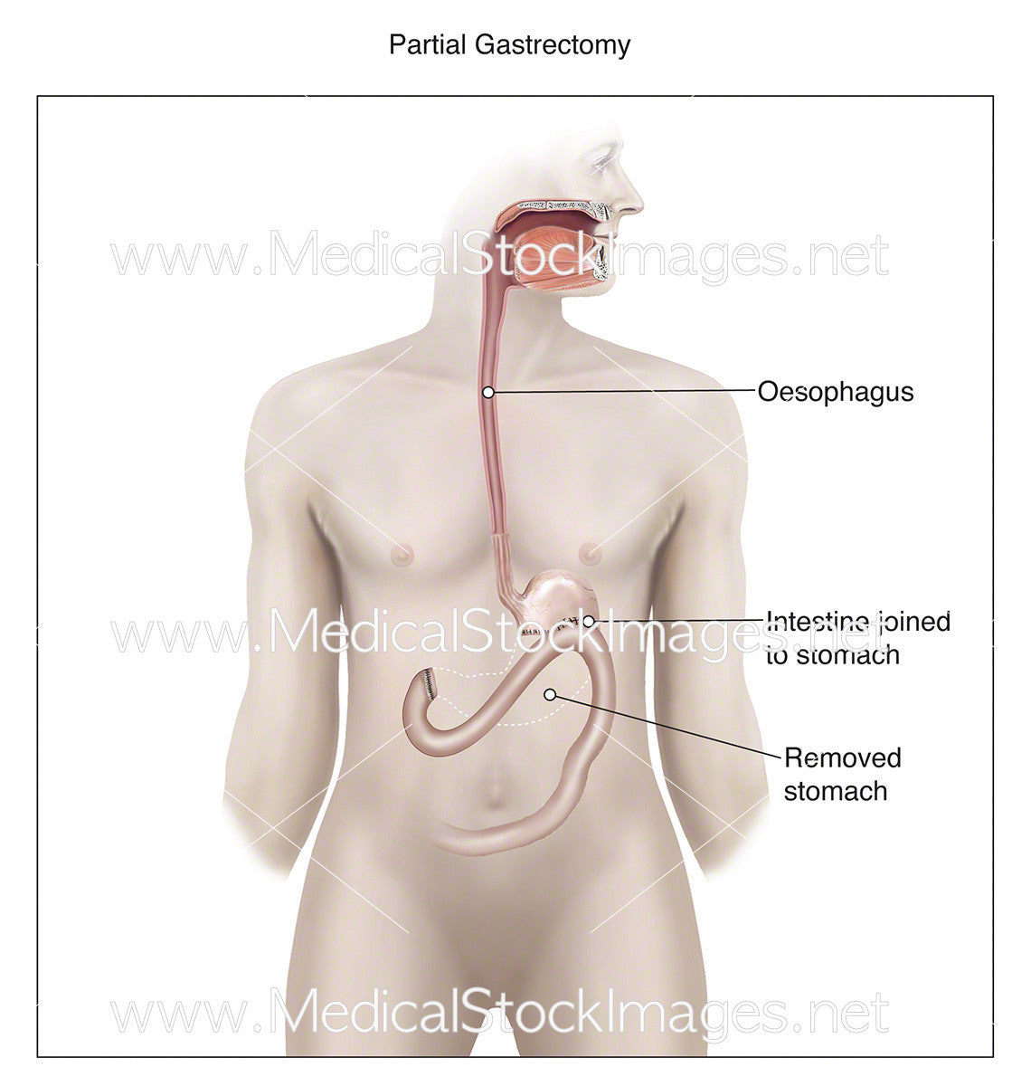 partial gastrectomy