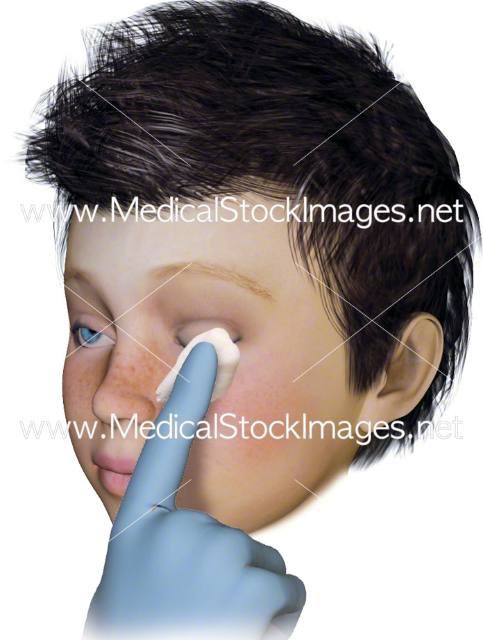 Medical Illustration Of Applying Eye Drops To License Medical Stock Images Company