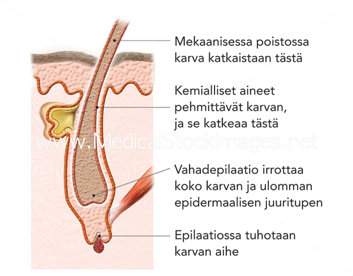 pubic hair laser removal