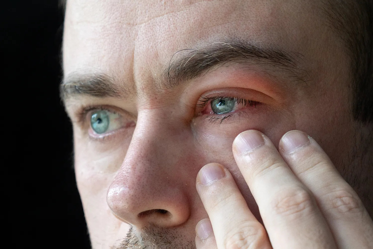 What Your Eye Doctor Wants You To Know About Blepharitis