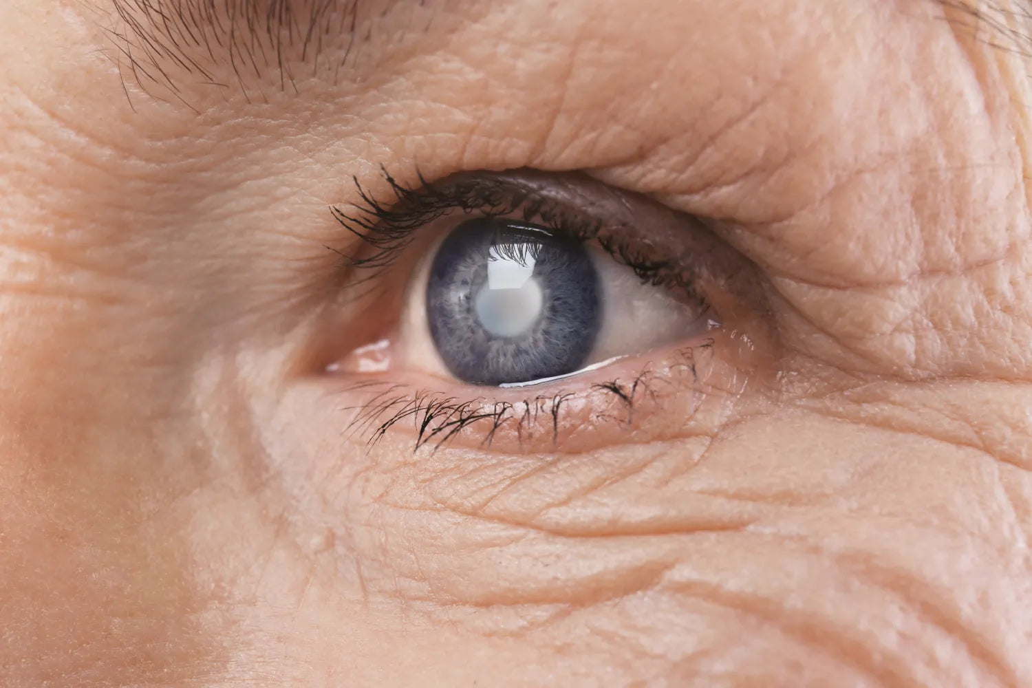 What Does Glaucoma Look Like?