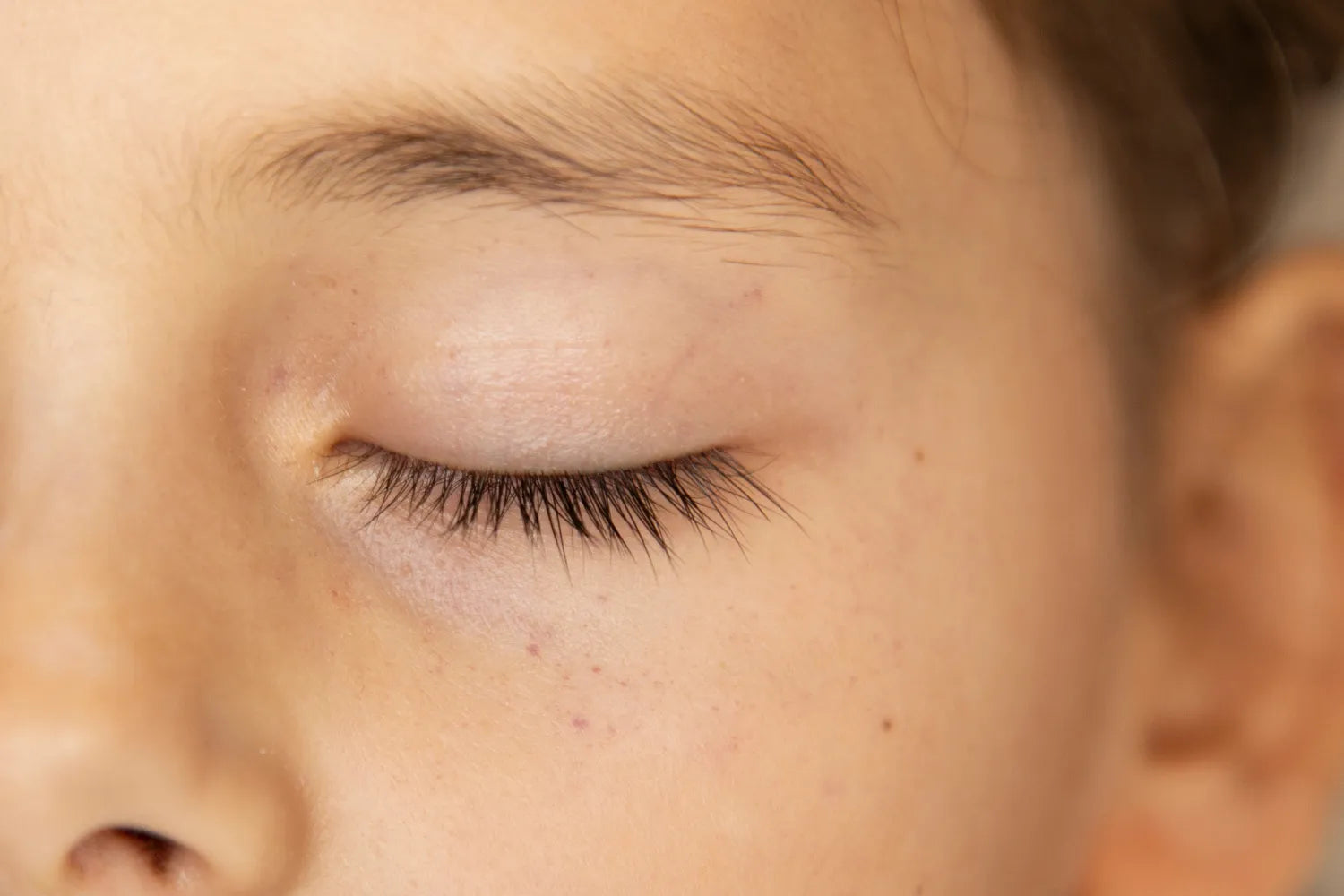 Petechiae in the Eyes: Signs, Causes, and Treatments