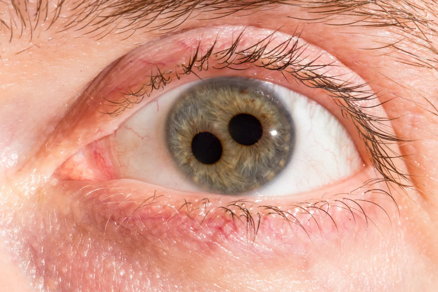 Understanding Polycoria: Is Two Pupils in One Eye Possible?